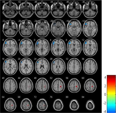 Cerebral blood flow in adolescents with drug-naive, first-episode major depressive disorder: An arterial spin labeling study based on voxel-level whole-brain analysis